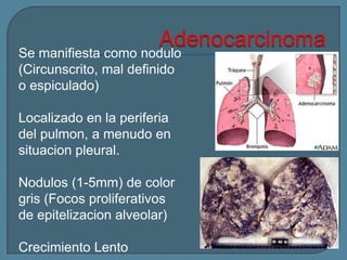 Se manifiesta como nodulo
(Circunscrito, mal definido
o espiculado)
Localizado en la periferia
del pulmon, a menudo en
situacion pleural.
Nodulos (1-5mm) de color
gris (Focos proliferativos
de epitelizacion alveolar)
Crecimiento Lento

 