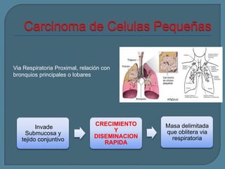 Via Respiratoria Proximal, relación con
bronquios principales o lobares

Invade
Submucosa y
tejido conjuntivo

CRECIMIENTO
Y
DISEMINACION
RAPIDA

Masa delimitada
que oblitera via
respiratoria

 