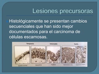  Histológicamente

se presentan cambios
secuenciales que han sido mejor
documentados para el carcinoma de
células escamosas.

 