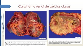 Carcinoma renal de células claras
 