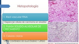 Histopatología
1. Red vascular FINA
• Separa las células de carcinoma en alveólos
2. Patrón SOLIDO-ALVEOLAR DE
CRECIMIENTO
3. Celulas claras
• POR CONTENIDO DE GLUCÓGENO Y LÍPIDO
 