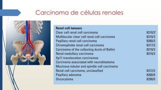 Carcinoma de células renales
 