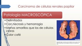 Carcinoma de células renales papilar
Patología MACROSCÓPICA
•Delimitados
•Con necrosis y hemorragia
•Menos amarillos que los de células
claras
•Color café
 
