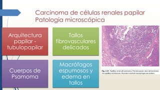 Carcinoma de células renales papilar
Patología microscópica
Arquitectura
papilar -
tubulopapilar
Tallos
fibrovasculares
delicados
Cuerpos de
Psamoma
Macrófagos
espumosos y
edema en
tallos
 