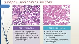 Subtipos… una cosa es una cosa
Tipo 1, tranquilo…
• Nucleos de bajo grado
• Papilas con una capa de
células (citoplasma escaso)
• Tallos delicados con edema
y macrófagos
Tipo 2, más canijo…
• Grado nuclear alto
• Estratificación de células
(citoplasma eosinófilo
abundante)
• Tallos fibrosos y con menos
macrófagos
 
