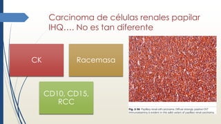 Carcinoma de células renales papilar
IHQ…. No es tan diferente
CK Racemasa
CD10, CD15,
RCC
 