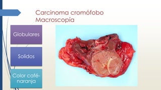 Carcinoma cromófobo
Macroscopía
Globulares
Solidos
Color café-
naranja
 