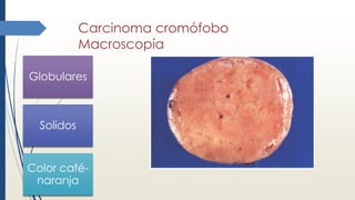 Carcinoma cromófobo
Macroscopía
Globulares
Solidos
Color café-
naranja
 