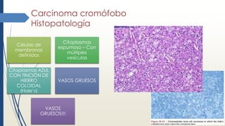 Carcinoma cromófobo
Histopatología
Células de
membranas
definidas
Citoplasmas
espumoso – Con
múltiples
vesículas
Citoplasmas AZUL
CON TINCIÓN DE
HIERRO
COLOIDAL
(Hale’s)
VASOS GRUESOS
VASOS
GRUESOS!!!
 
