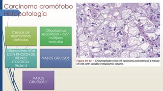 Carcinoma cromófobo
Histopatología
Células de
membranas
definidas
Citoplasmas
espumoso – Con
múltiples
vesículas
Citoplasmas AZUL
CON TINCIÓN DE
HIERRO
COLOIDAL
(Hale’s)
VASOS GRUESOS
VASOS
GRUESOS!!!
 