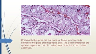 Chromophobe renal cell carcinoma. Some tumors consist
entirely of the pale chromophobe cells. The cell membranes are
quite conspicuous, and it can be noted that this is not a clear
cell lesion.
 