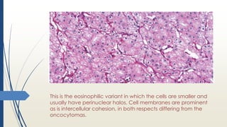 This is the eosinophilic variant in which the cells are smaller and
usually have perinuclear halos. Cell membranes are prominent
as is intercellular cohesion, in both respects differing from the
oncocytomas.
 
