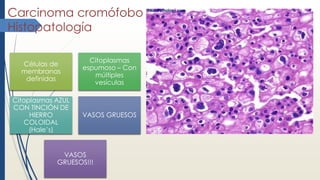 Carcinoma cromófobo
Histopatología
Células de
membranas
definidas
Citoplasmas
espumoso – Con
múltiples
vesículas
Citoplasmas AZUL
CON TINCIÓN DE
HIERRO
COLOIDAL
(Hale’s)
VASOS GRUESOS
VASOS
GRUESOS!!!
 