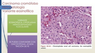Carcinoma cromófobo
Histopatología
Variante eosinofílica
VARIANTE
EOSINOFÍLICA, CITOPLASMA
MENOS ESPUMOSO-
FLOCULANTE
SE PUEDE CONFUNDIR CON
ONCOCITOMA, AYUDA
TINCIÓN DE FE
 
