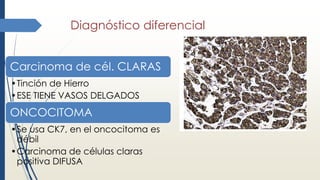 Diagnóstico diferencial
Carcinoma de cél. CLARAS
•Tinción de Hierro
•ESE TIENE VASOS DELGADOS
ONCOCITOMA
•Se usa CK7, en el oncocitoma es
débil
•Carcinoma de células claras
positiva DIFUSA
 