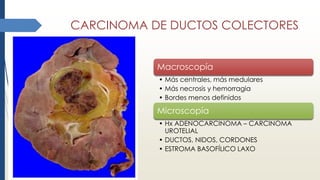 CARCINOMA DE DUCTOS COLECTORES
Macroscopía
• Más centrales, más medulares
• Más necrosis y hemorragia
• Bordes menos definidos
Microscopía
• Hx ADENOCARCINOMA – CARCINOMA
UROTELIAL
• DUCTOS, NIDOS, CORDONES
• ESTROMA BASOFÍLICO LAXO
 
