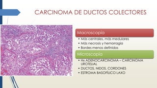 CARCINOMA DE DUCTOS COLECTORES
Macroscopía
• Más centrales, más medulares
• Más necrosis y hemorragia
• Bordes menos definidos
Microscopía
• Hx ADENOCARCINOMA – CARCINOMA
UROTELIAL
• DUCTOS, NIDOS, CORDONES
• ESTROMA BASOFÍLICO LAXO
 
