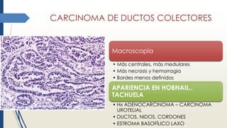CARCINOMA DE DUCTOS COLECTORES
Macroscopía
• Más centrales, más medulares
• Más necrosis y hemorragia
• Bordes menos definidos
APARIENCIA EN HOBNAIL..
TACHUELA
• Hx ADENOCARCINOMA – CARCINOMA
UROTELIAL
• DUCTOS, NIDOS, CORDONES
• ESTROMA BASOFÍLICO LAXO
 