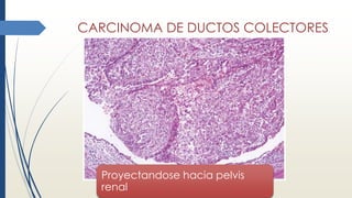 CARCINOMA DE DUCTOS COLECTORES
Proyectandose hacia pelvis
renal
 