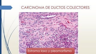 CARCINOMA DE DUCTOS COLECTORES
Estroma laxo y pleomorfismo
 