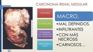CARCINOMA RENAL MEDULAR
10-40 AÑOS
2:1 Masculino
> Pacientes
con anemia de
cél. Falciformes
PRONOSTICO
MALO
MACRO,
•MAL DEFINIDOS,
•INFILTRANTES
•CON MÁS
NECROSIS
•CARNOSOS…
 