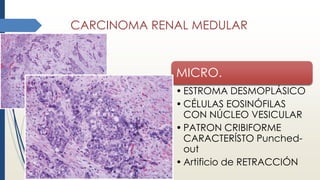 CARCINOMA RENAL MEDULAR
MICRO.
• ESTROMA DESMOPLÁSICO
• CÉLULAS EOSINÓFILAS
CON NÚCLEO VESICULAR
• PATRON CRIBIFORME
CARACTERÍSTO Punched-
out
• Artificio de RETRACCIÓN
 
