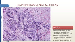 CARCINOMA RENAL MEDULAR
MICRO.
•ESTROMA DESMOPLÁSICO
•CÉLULAS EOSINÓFILAS
CON NÚCLEO VESICULAR
•PATRON CRIBIFORME
CARACTERÍSTO Punched-
out
•Artificio de RETRACCIÓN
 