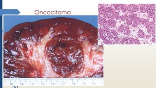 Oncocitoma
 
