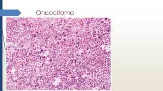 Oncocitoma
 