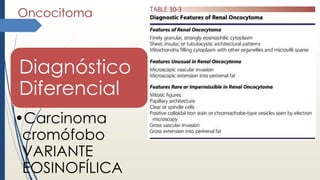Oncocitoma
Diagnóstico
Diferencial
•Carcinoma
cromófobo
VARIANTE
EOSINOFÍLICA
 
