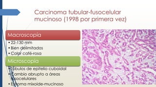 Carcinoma tubular-fusocelular
mucinoso (1998 por primera vez)
Macroscopía
•22-130 mm
•Bien delimitados
•Color café-rosa
Microscopía
•Túbulos de epitelio cuboidal
•Cambio abrupto a áreas
fusocelulares
•Estroma mixoide-mucinoso
 