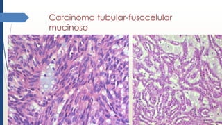 Carcinoma tubular-fusocelular
mucinoso
 