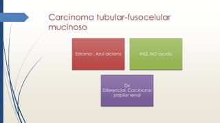 Carcinoma tubular-fusocelular
mucinoso
Estroma : Azul alciano IHQ, NO ayuda
Dx
Diferencial, Carcinoma
papilar renal
 