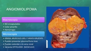 ANGIOMIOLIPOMA
Macroscopía
• NO encapsulados
• Color amarillo
• Hemorragia
Microscopía
• GRASA, MUSCULO LISO, Y VASOS GRUESOS
• Pueden presentar pleomorfismo leve
• Pueden extender a la vena renal
• Variante EPITELIODE (MÚSCULO)
 