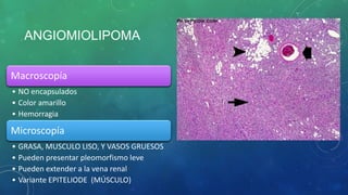 ANGIOMIOLIPOMA
Macroscopía
• NO encapsulados
• Color amarillo
• Hemorragia
Microscopía
• GRASA, MUSCULO LISO, Y VASOS GRUESOS
• Pueden presentar pleomorfismo leve
• Pueden extender a la vena renal
• Variante EPITELIODE (MÚSCULO)
 