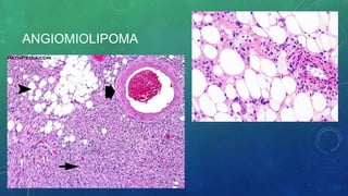 ANGIOMIOLIPOMA
 