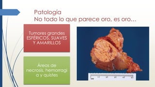 Patología
No todo lo que parece oro, es oro…
Tumores grandes
ESFÉRICOS, SUAVES
Y AMARILLOS
Áreas de
necrosis, hemorragi
a y quistes
 