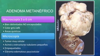 ADENOMA METANÉFRICO
Macroscopía 3 a 6 cm
• Bien delimitados NO encapsulados
• Color gris-café
• Áreas quisticas
Microscopía
• Tumor muy celular
• Acinos y estructuras tubulares pequeños
• Empaquetados
• Estroma edematoso paucicelular
 