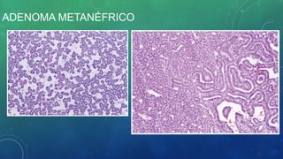 ADENOMA METANÉFRICO
 