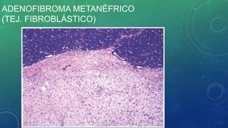 ADENOFIBROMA METANÉFRICO
(TEJ. FIBROBLÁSTICO)
 