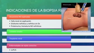 INDICACIONES DE LA BIOPSIA RENAL
• Falla renal sin explicación
• Síndrome nefrótico y nefrítico sin Dx
• Proteinuria y hematuria NO nefróticas
Situaciones NO explicadas
Tumores renales
Trasplante renal
• LUPUS
Enfermedades de tejido conectivo
 