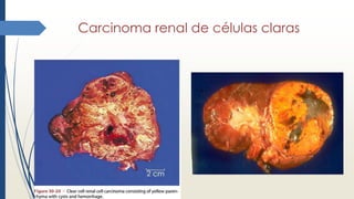 Carcinoma renal de células claras
 