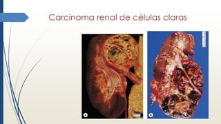 Carcinoma renal de células claras
 