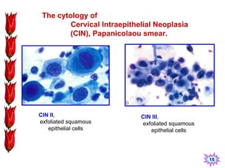 Neoplasia, two | PPT
