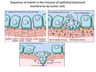 Sequence of events in the invasion of epithelial basement
membranes by tumor cells.
 