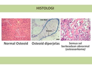 Normal Osteoid Osteoid diperjelas Semua sel
berkeadaan abnormal
(osteosarkoma)
HISTOLOGI
 