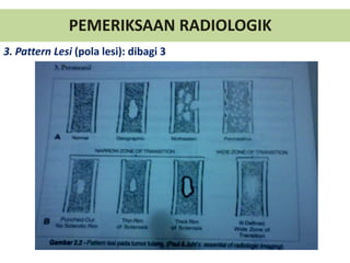 PEMERIKSAAN RADIOLOGIK
3. Pattern Lesi (pola lesi): dibagi 3
 