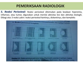 PEMERIKSAAN RADIOLOGIK
5. Reaksi Periosteal: Reaksi periosteal ditemukan pada keadaan hiperemia,
inflamasi, atau tumor, digunakan untuk menilai aktivitas lesi dan aktivitas biologik.
Dibagi atas 3 reaksi yakni: reaksi periosteal kontinyu, diskontinyu, dan kompleks
 