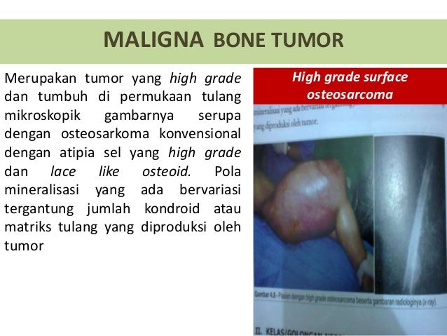 Tumor Tulang Bone Neoplasma