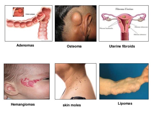 Neoplasm icd 10 guideline Neoplasm icd 10 guideline
